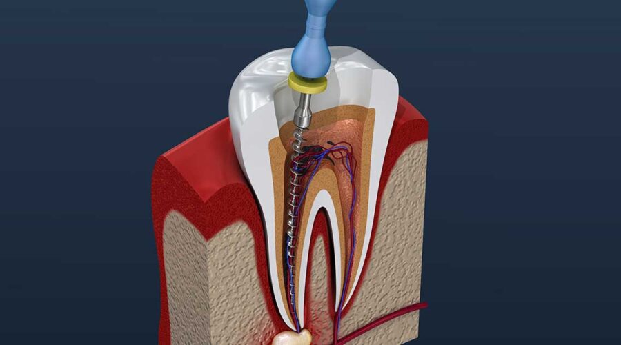 Root Canals Reconsidered: Risks & Alternatives